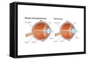 Farsighted Eye (Hyperopia). Convex Lens, Ophthalmology, Health and Disease-Encyclopaedia Britannica-Framed Stretched Canvas