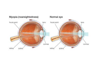 'Farsighted Eye (Hyperopia). Convex Lens, Ophthalmology, Health and ...