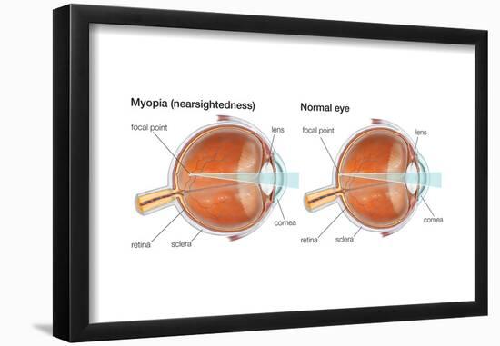 Farsighted Eye (Hyperopia). Convex Lens, Ophthalmology, Health and Disease-Encyclopaedia Britannica-Framed Poster