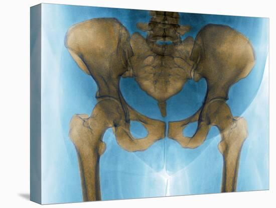 Female Pelvis, X-ray-Du Cane Medical-Stretched Canvas