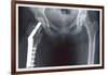 Femur Repair-null-Framed Art Print