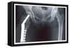 Femur Repair-null-Framed Stretched Canvas