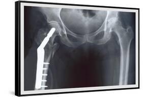 Femur Repair-null-Framed Stretched Canvas