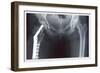 Femur Repair-null-Framed Premium Giclee Print