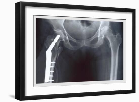 Femur Repair-null-Framed Premium Giclee Print