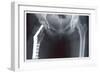 Femur Repair-null-Framed Premium Giclee Print