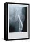 Fixed Femur-null-Framed Stretched Canvas