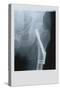 Fixed Femur-null-Stretched Canvas