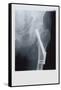 Fixed Femur-null-Framed Stretched Canvas