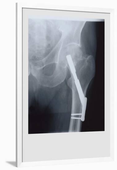 Fixed Femur-null-Framed Art Print