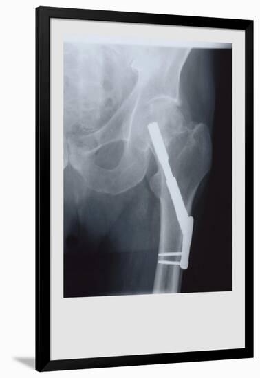 Fixed Femur-null-Framed Art Print