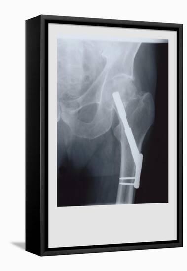 Fixed Femur-null-Framed Stretched Canvas