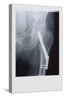 Fixed Femur-null-Stretched Canvas