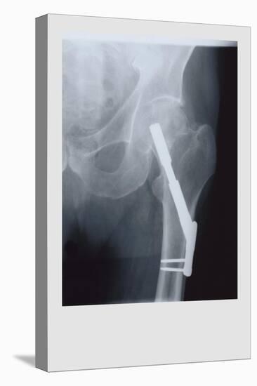 Fixed Femur-null-Stretched Canvas