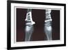 Fixed Tibia-null-Framed Premium Giclee Print