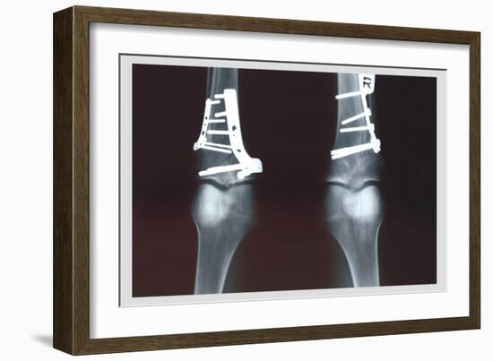 Fixed Tibia-null-Framed Art Print