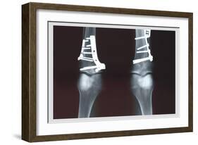 Fixed Tibia-null-Framed Art Print