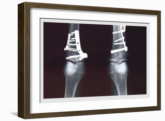 Fixed Tibia-null-Framed Premium Giclee Print