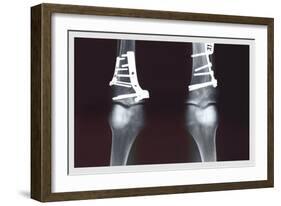 Fixed Tibia-null-Framed Premium Giclee Print