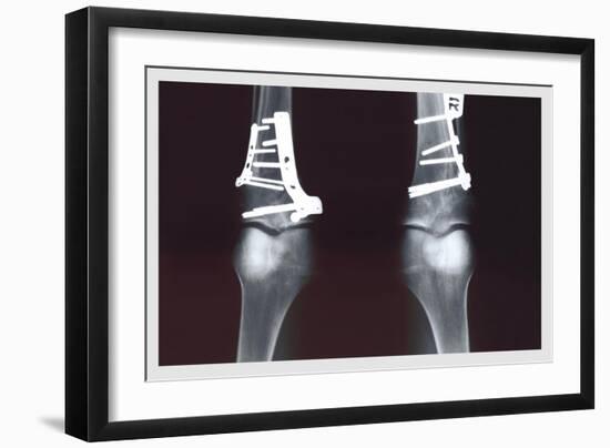 Fixed Tibia-null-Framed Premium Giclee Print