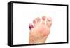 Foot Problems, Broken Toe and Calluses-soupstock-Framed Stretched Canvas
