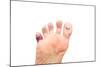 Foot Problems, Broken Toe and Calluses-soupstock-Mounted Photographic Print