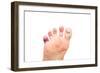 Foot Problems, Broken Toe and Calluses-soupstock-Framed Photographic Print