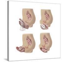 Four Methods of Female Contraception-null-Stretched Canvas