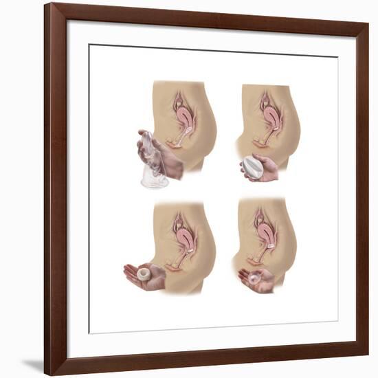 Four Methods of Female Contraception-null-Framed Art Print