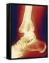 Fractured Ankle, X-ray-Miriam Maslo-Framed Stretched Canvas