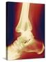 Fractured Ankle, X-ray-Miriam Maslo-Stretched Canvas