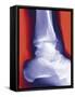 Fractured Ankle, X-ray-Miriam Maslo-Framed Stretched Canvas