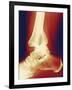 Fractured Ankle, X-ray-Miriam Maslo-Framed Photographic Print