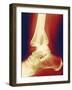 Fractured Ankle, X-ray-Miriam Maslo-Framed Photographic Print