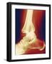 Fractured Ankle, X-ray-Miriam Maslo-Framed Photographic Print