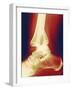 Fractured Ankle, X-ray-Miriam Maslo-Framed Photographic Print