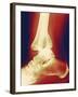 Fractured Ankle, X-ray-Miriam Maslo-Framed Photographic Print