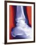 Fractured Ankle, X-ray-Miriam Maslo-Framed Photographic Print