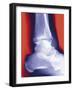 Fractured Ankle, X-ray-Miriam Maslo-Framed Photographic Print