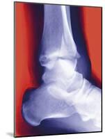 Fractured Ankle, X-ray-Miriam Maslo-Mounted Photographic Print