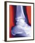 Fractured Ankle, X-ray-Miriam Maslo-Framed Photographic Print