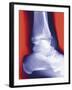 Fractured Ankle, X-ray-Miriam Maslo-Framed Photographic Print