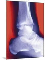 Fractured Ankle, X-ray-Miriam Maslo-Mounted Photographic Print