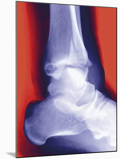 Fractured Ankle, X-ray-Miriam Maslo-Mounted Photographic Print