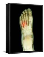 Fractured Foot, X-ray-Du Cane Medical-Framed Stretched Canvas