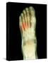 Fractured Foot, X-ray-Du Cane Medical-Stretched Canvas