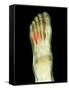 Fractured Foot, X-ray-Du Cane Medical-Framed Stretched Canvas