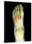 Fractured Foot, X-ray-Du Cane Medical-Stretched Canvas