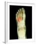 Fractured Foot, X-ray-Du Cane Medical-Framed Premium Photographic Print