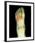 Fractured Foot, X-ray-Du Cane Medical-Framed Premium Photographic Print